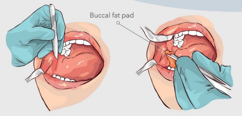 WIH Hospital What are the steps of a buccal fat removal procedure 03
