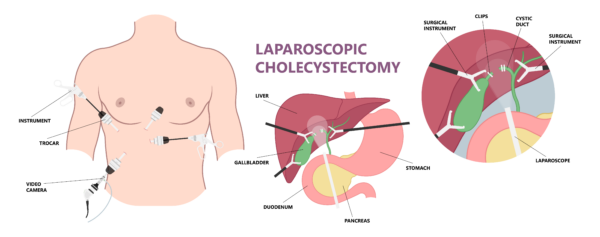 WIH Surgery Center Laparoscopic gallbladder surgery (Laparoscopic Cholecystectomy)