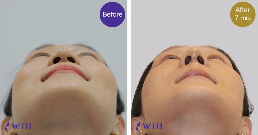 Crooked nose correction rib graft Bottom View