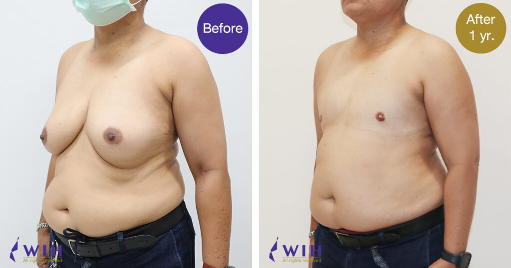 FTM Mastectomy 45 Left View