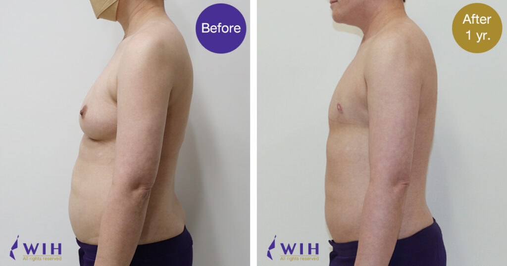 FTM Mastectomy Double incision technique Side view