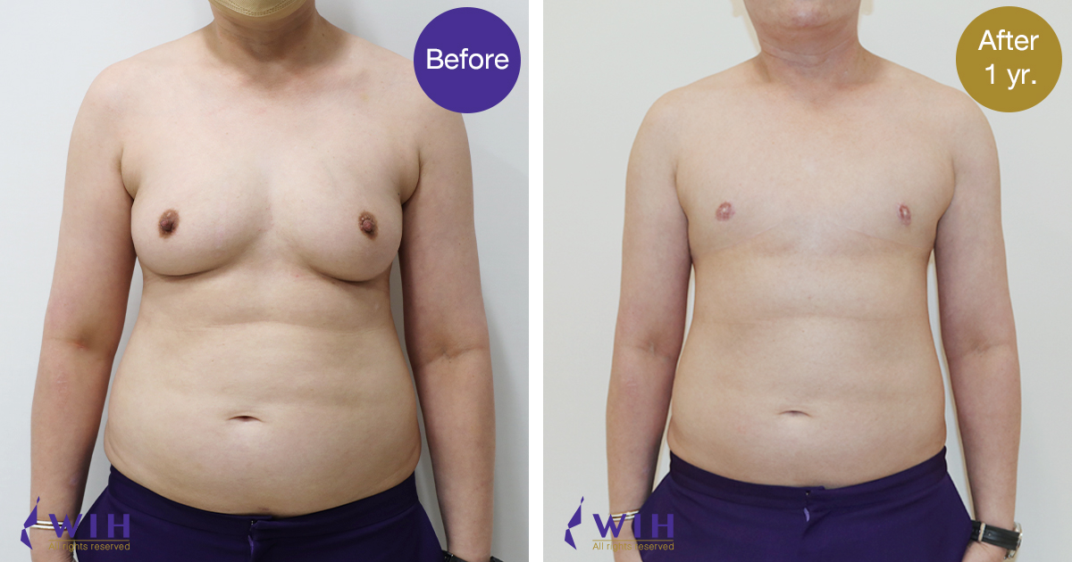 FTM Mastectomy Double incision technique front view