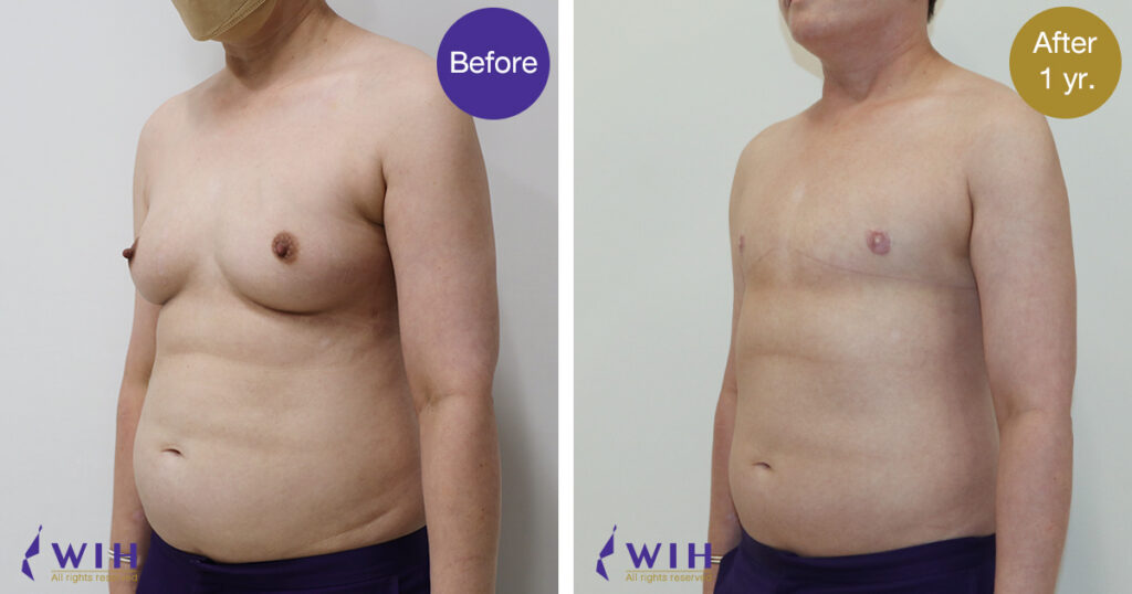 FTM Mastectomy Double incision technique front view 45