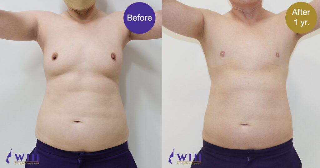 FTM Mastectomy Double incision technique front view hand up