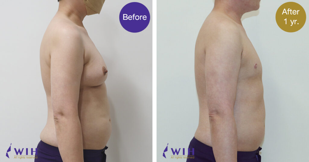 FTM Mastectomy Double incision technique right Side view