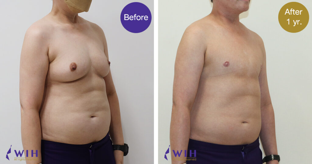 FTM Mastectomy Double incision technique right Side view 45