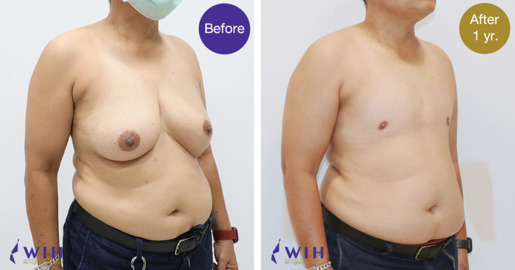FTM Mastectomy Right side View