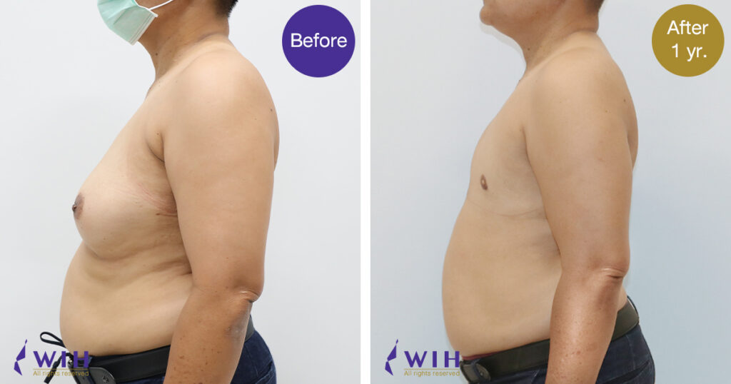 FTM Mastectomy Side Left view