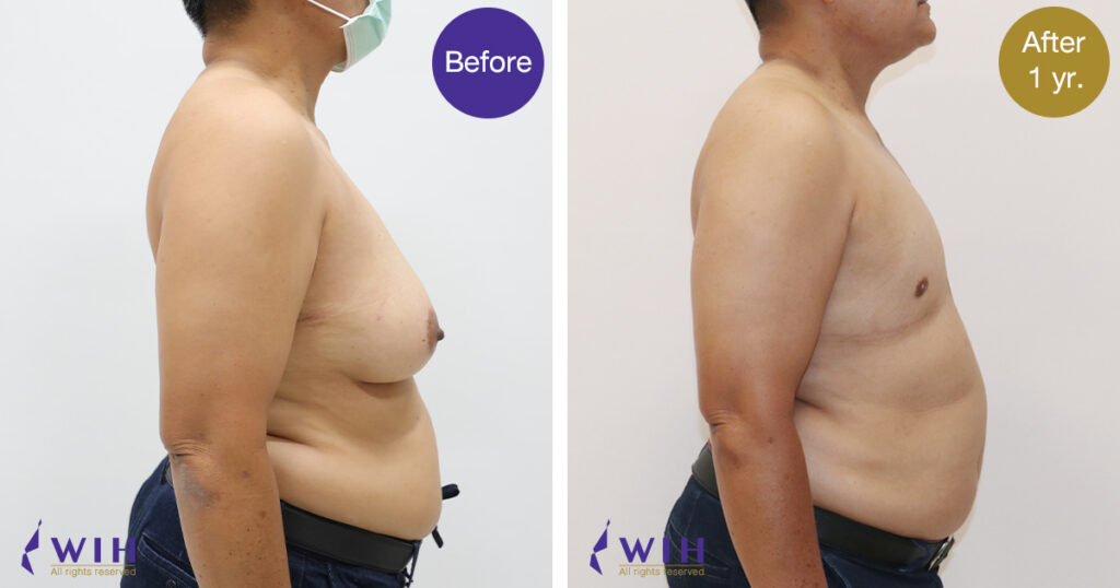 FTM Mastectomy Side View