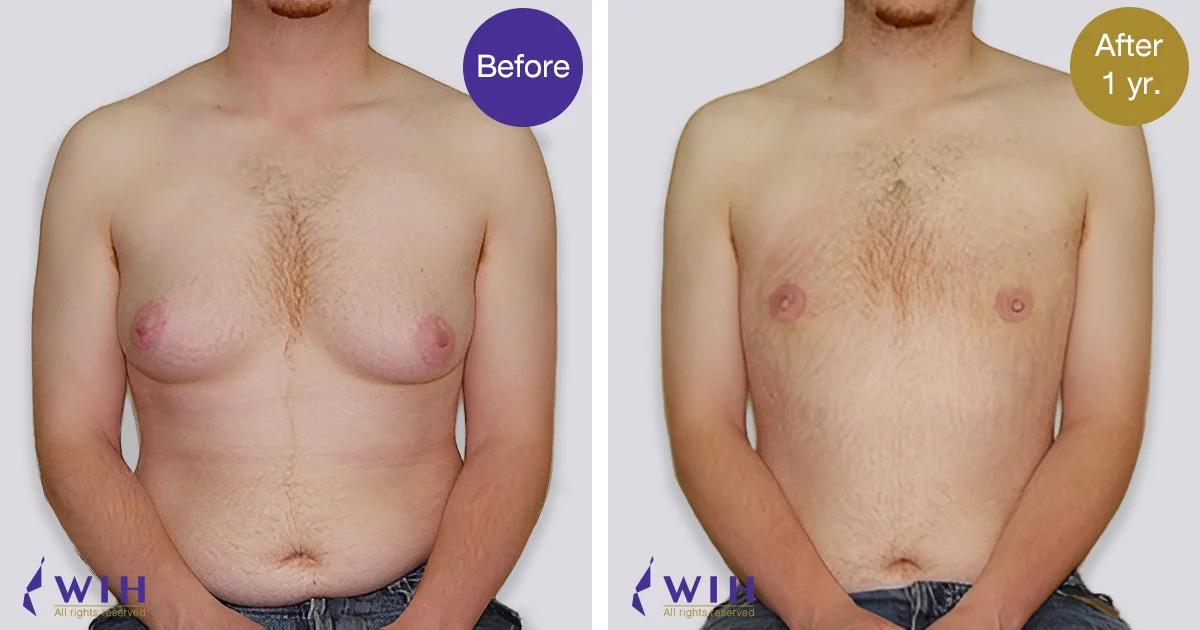 Female Male top surgery by doctor Chettawut Gallery after total breast removal surgery