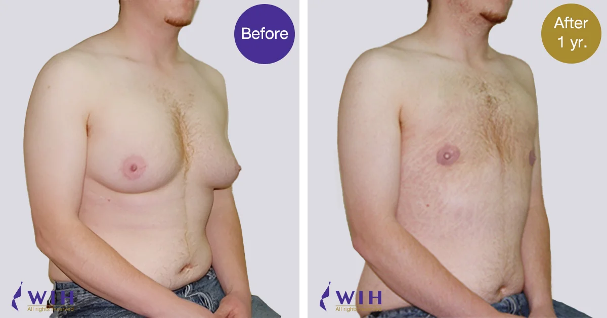 Female Male top surgery by doctor Chettawut Gallery after total breast removal surgery