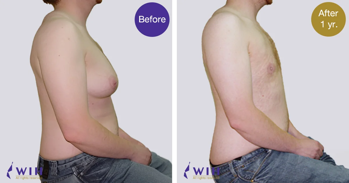 Female Male top surgery doctor Chettawut Gallery after total breast removal surgery