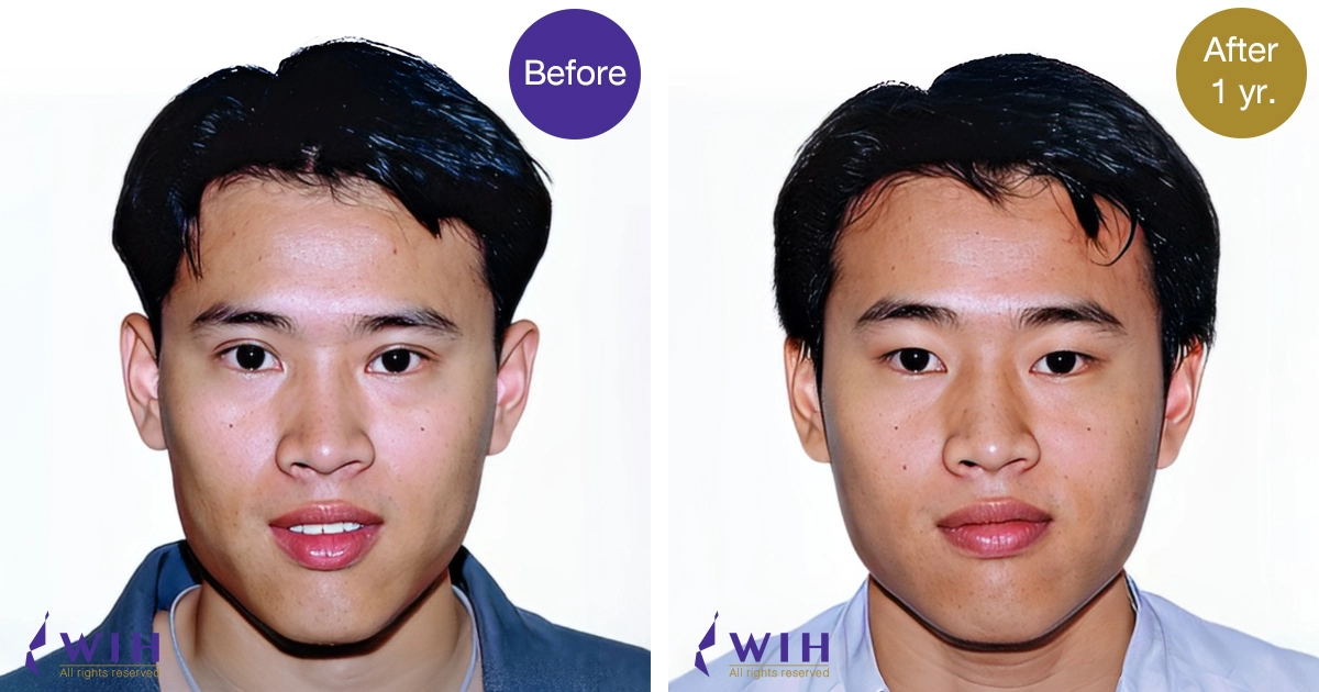 Double eyelid surgery medial