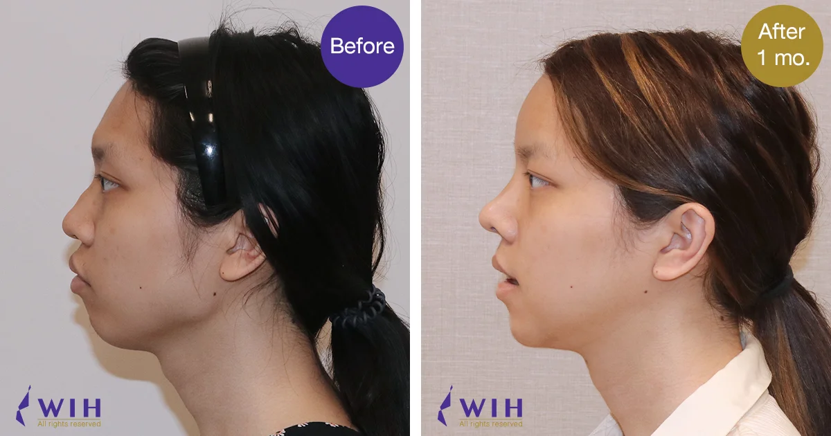 Open rhinoplasty with rib graft Left Side view