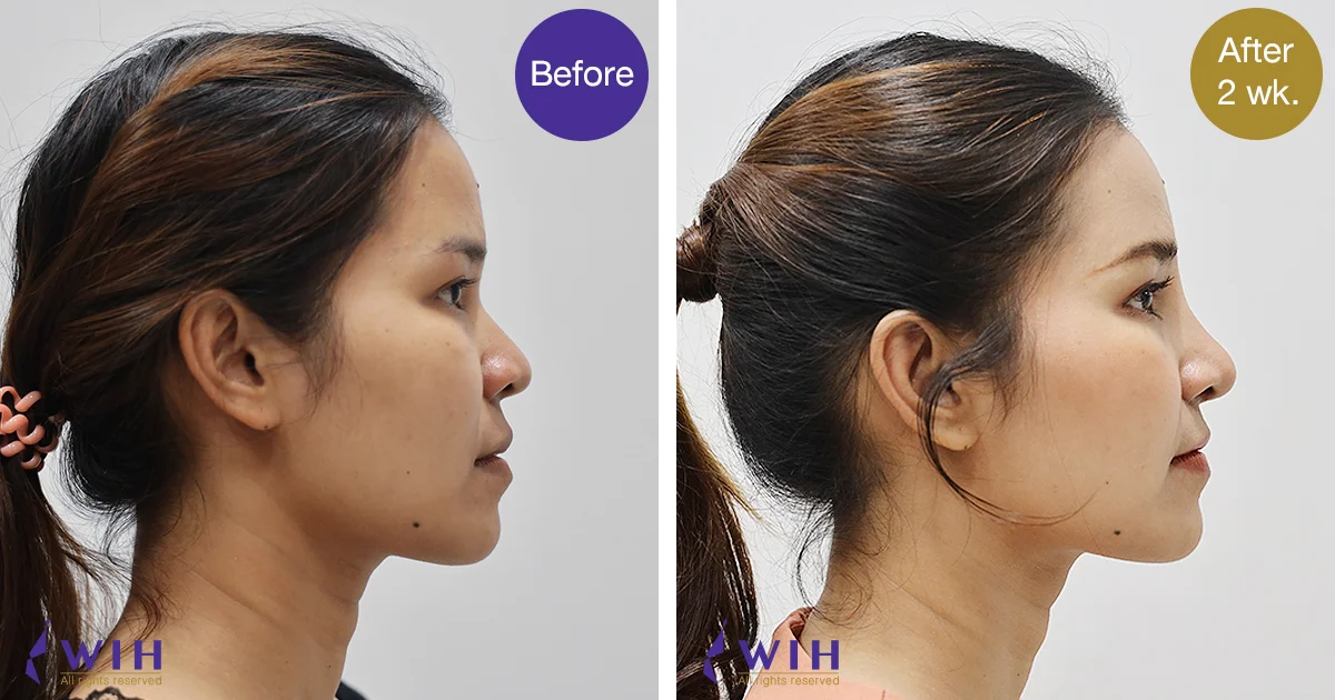 Open Rhinoplasty Thai front view before After Side
