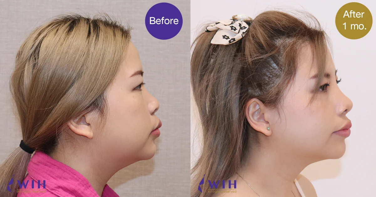 Rhinno side view