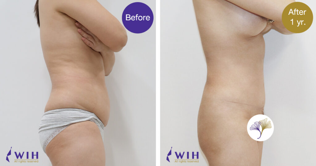 Tummy tuck right sIde view