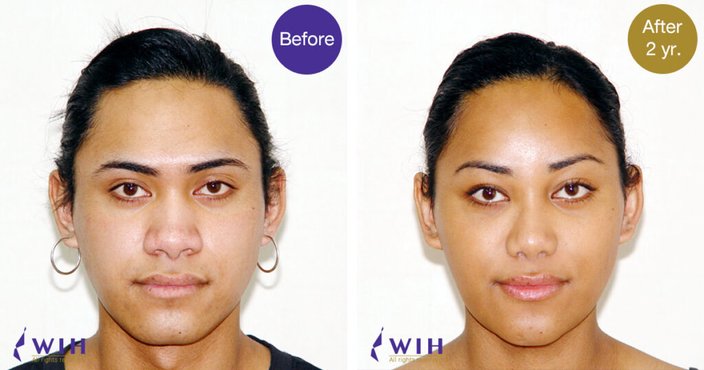 Facial Feminization Surgery (FFS) - WIH INTERNATIONAL HOSPITAL