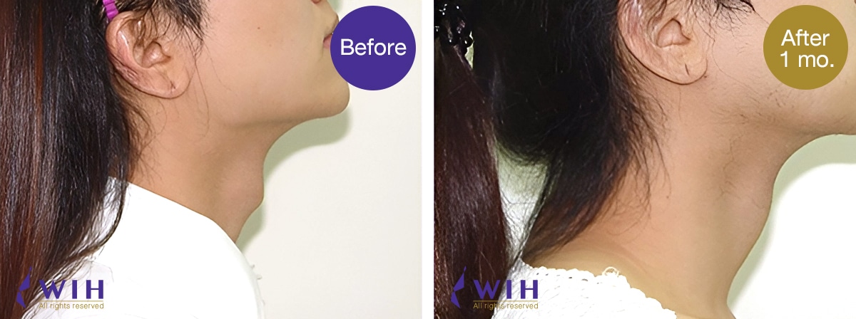 Adam apple shaving before and after by wih hospital