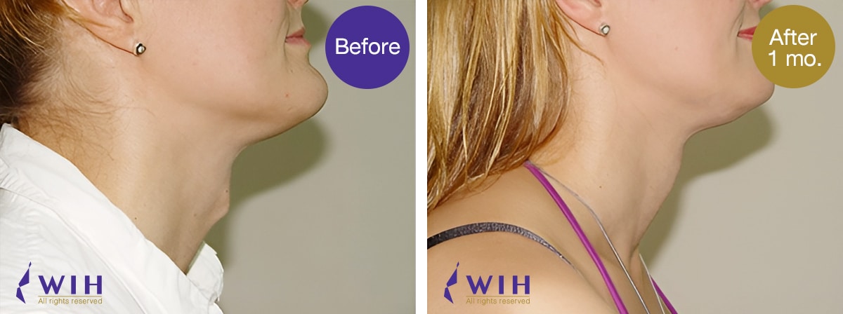 Adam's apple shaving before and after by wih hospital