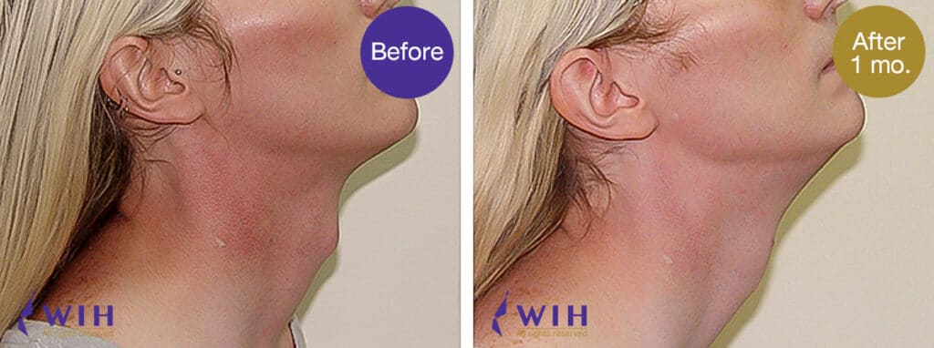 Trachea shave before and after by doctor chettawut