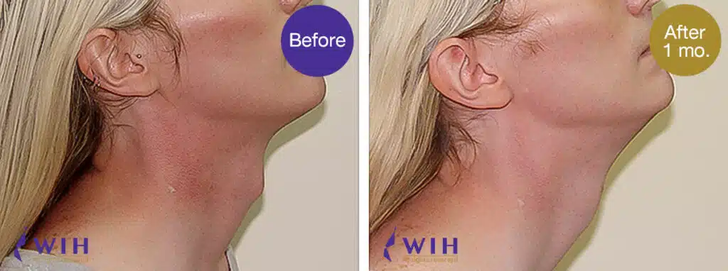 Trachea shave before and after by doctor chettawut