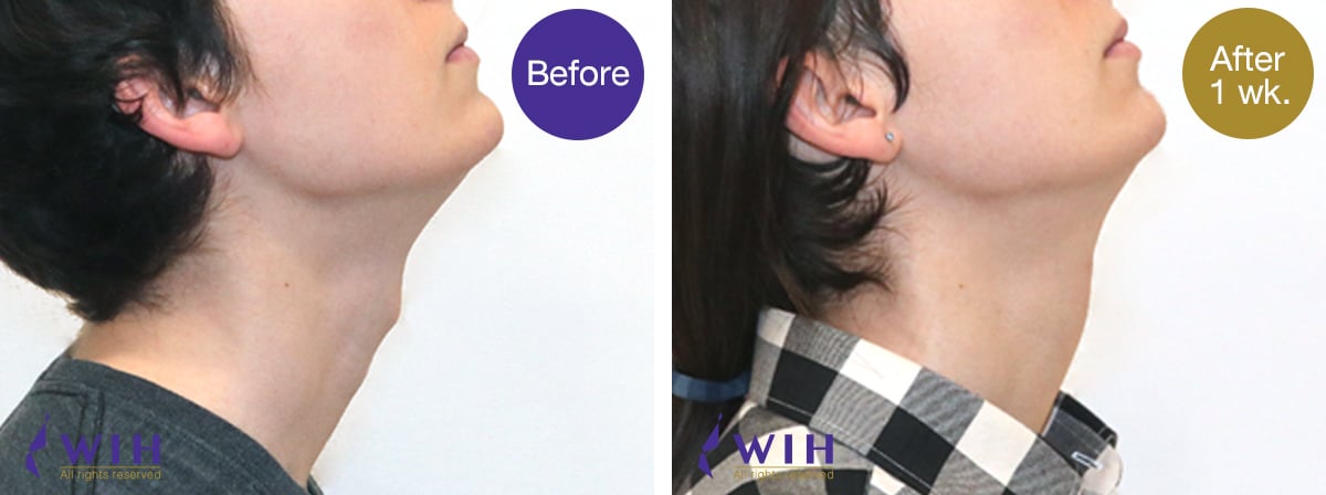 Adam's apple shaving