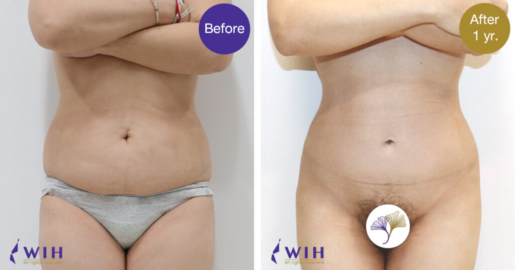 Tummy-tuck-Front-view