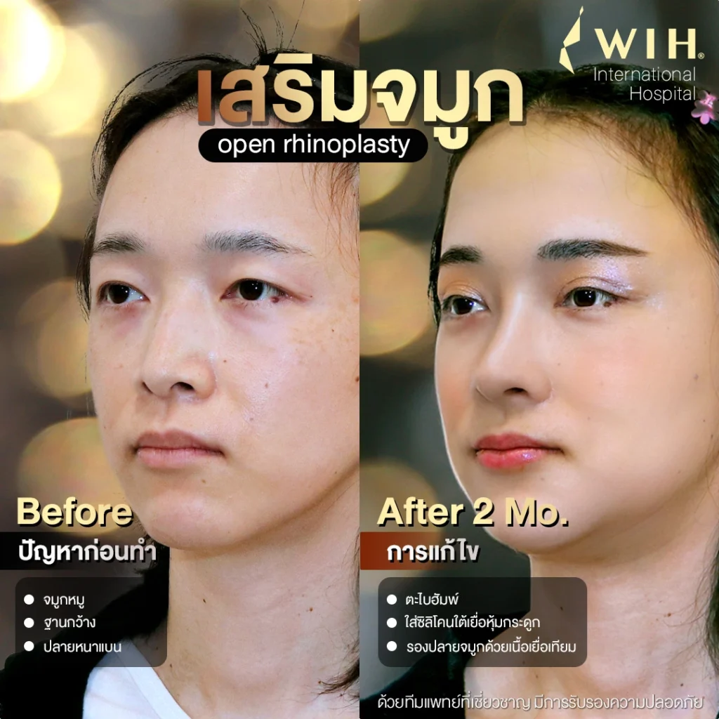 Before After เสริมจมูก open rhinoplasty ไอเพ่น