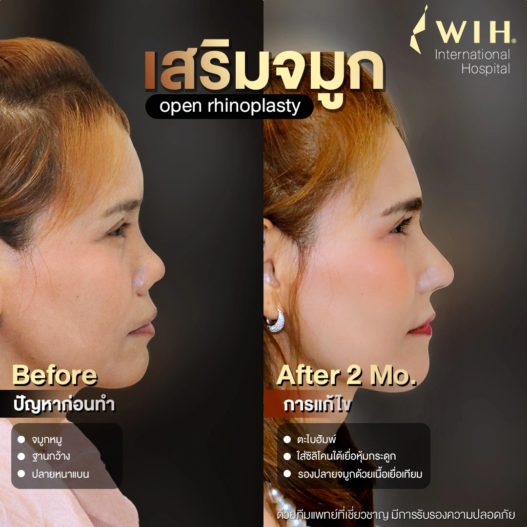 Before After เสริมจมูก open rhinoplasty ไอเพ่น