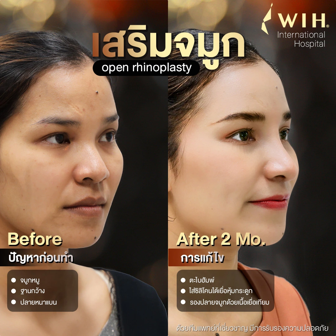 Before After เสริมจมูก open rhinoplasty ไอเพ่น