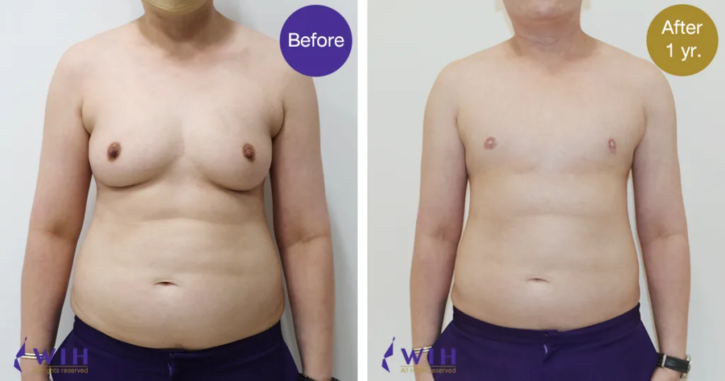 FTM-Mastectomy-Double-incision-technique-front-view-1-1024x538-1
