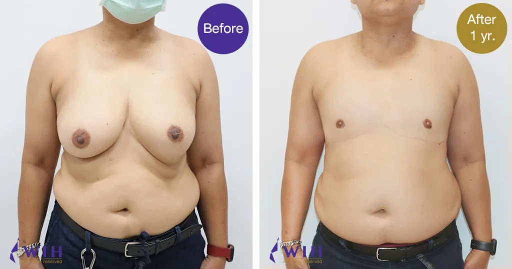 FTM-Mastectomy-Front-View-2-1024x538-1