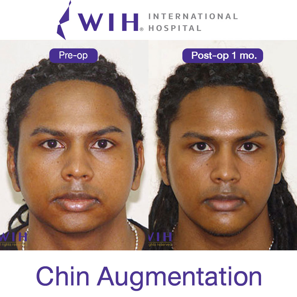 Chin Augmentation Surgery