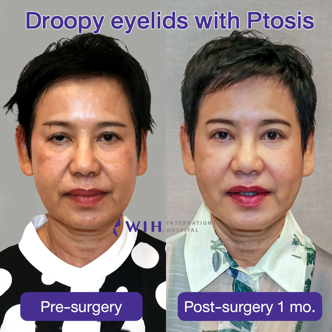 Eyelid Surgery