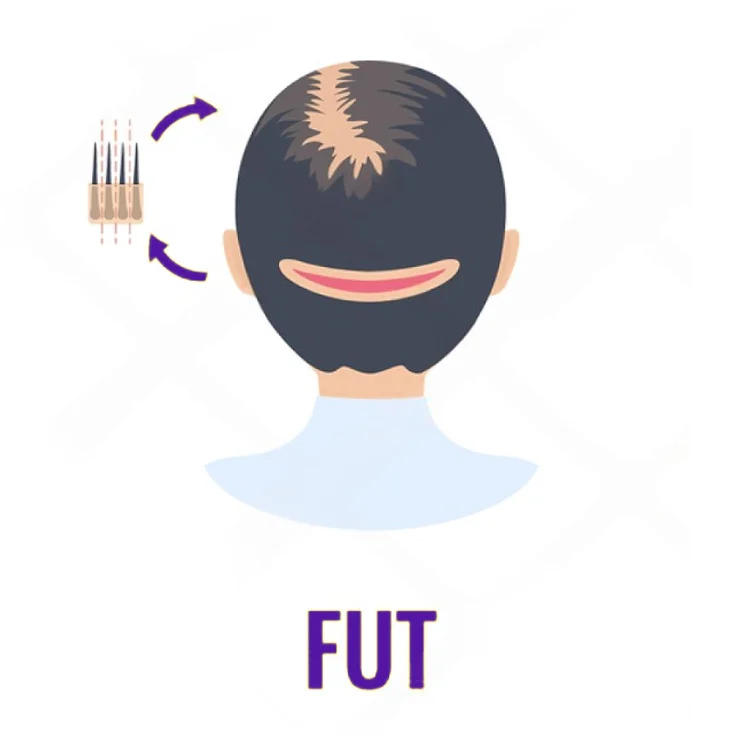 FUT Hair Transplant