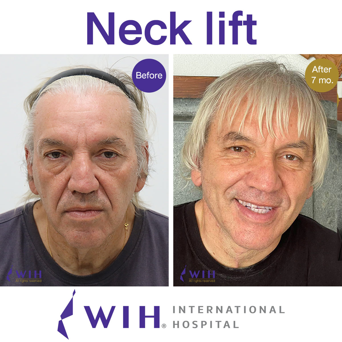 Neck Lift