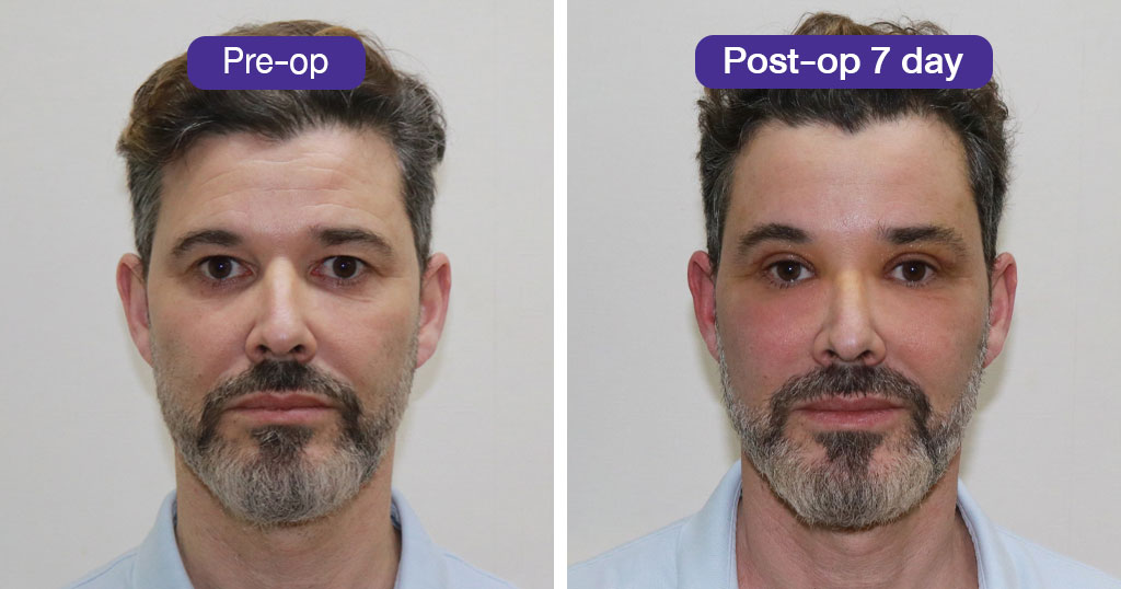 Brow Lift Surgery