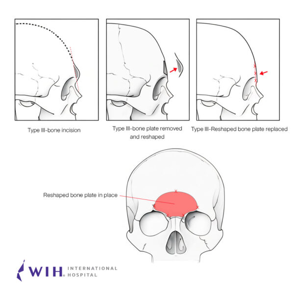 Brow Bone Reduction Surgery WIH Hospital | Forehead Contouring