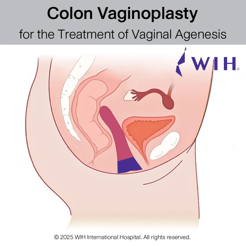 Colon Vaginoplasty for the Treatment of Vaginal Agenesis