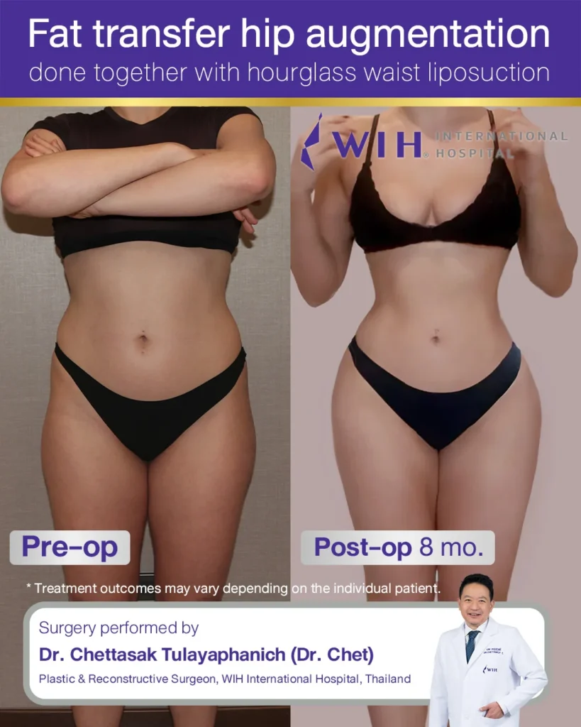 Hip Augmentation WIH International Hospital, Thailand