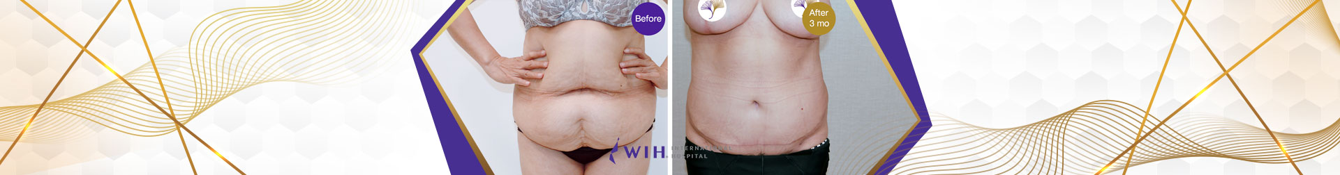 Tummy Tuck WIH Hospital