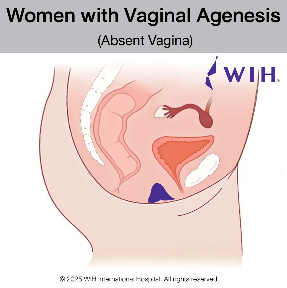 Women with Vaginal Agenesis (Absent Vagina)