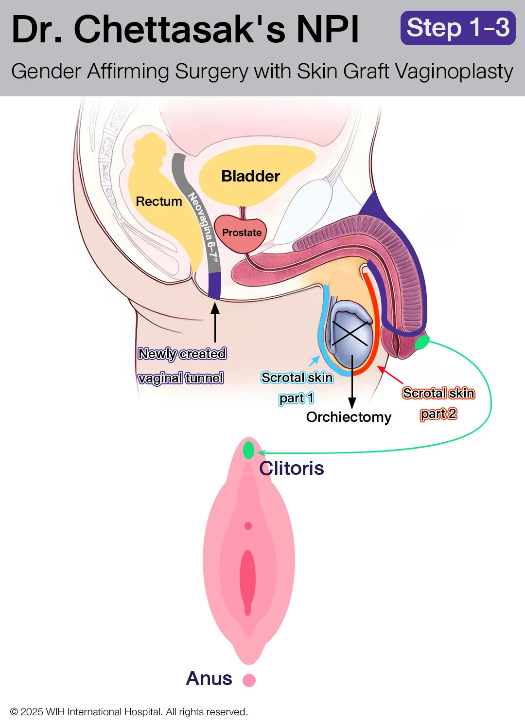 Dr. Chet's NPI Gender Affirming Surgery with Skin Graft Vaginoplasty step 1-3