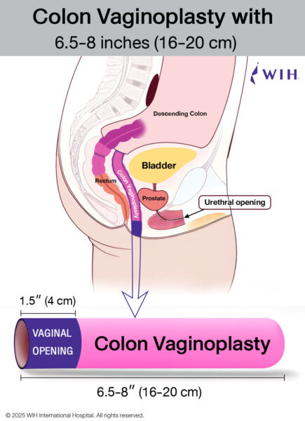 Colon Vaginoplasty Bangkok: Dr. Chettasak's Advanced GRS