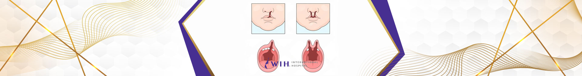 Cleft Lip and Palate Correction
