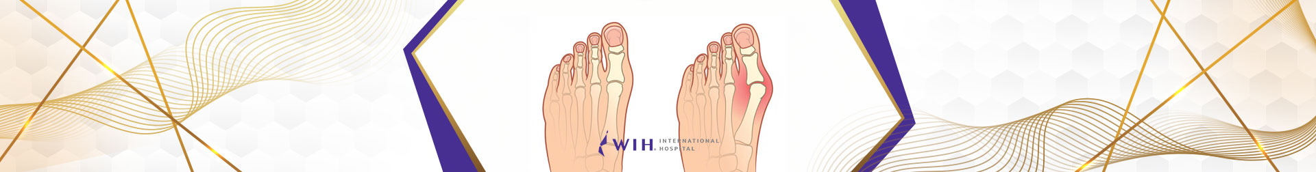 Hallux Valgus