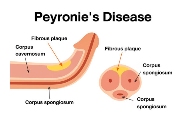 Peyronies Disease Treatment