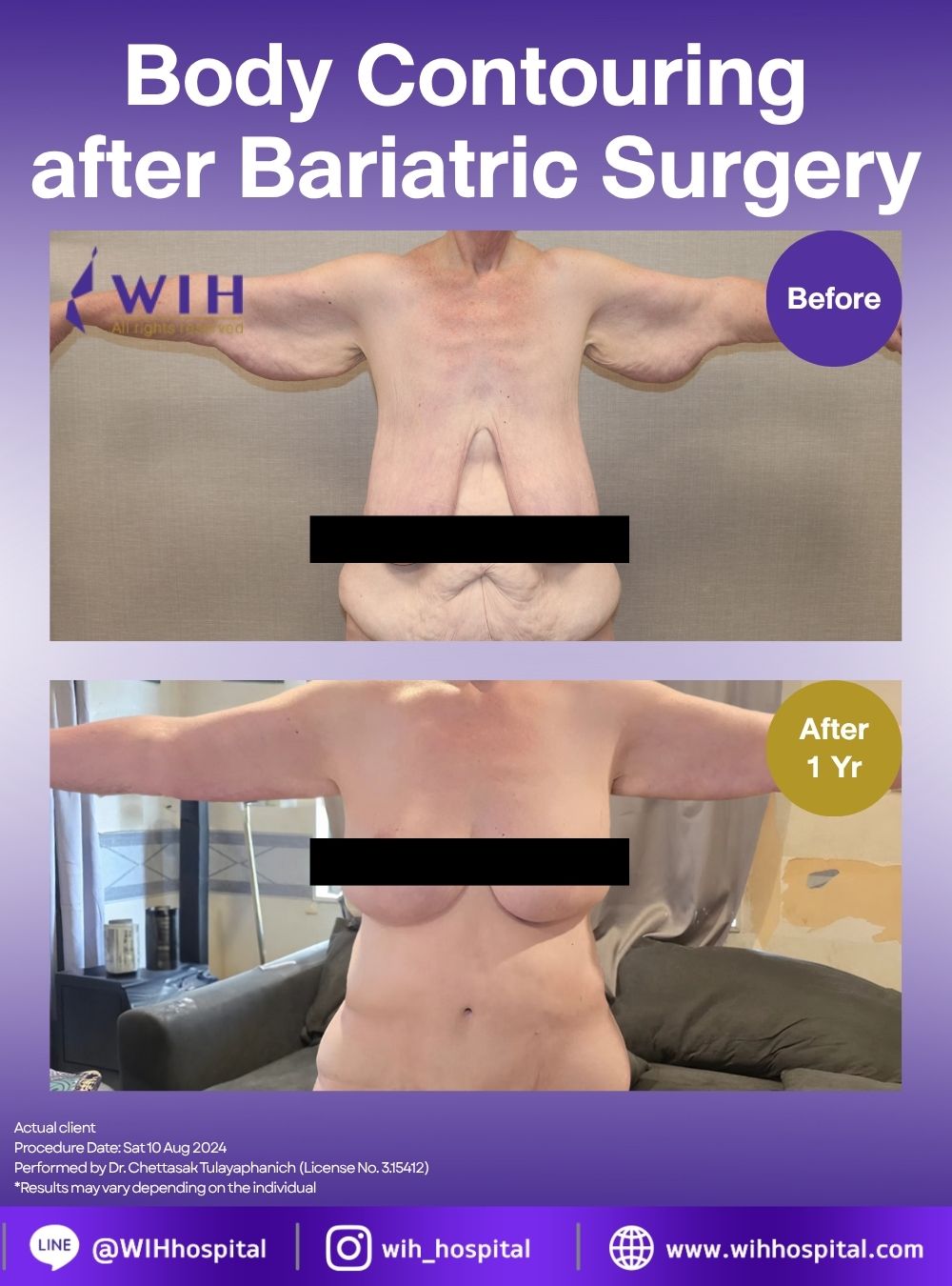 Body Contouring After Massive Weight Loss