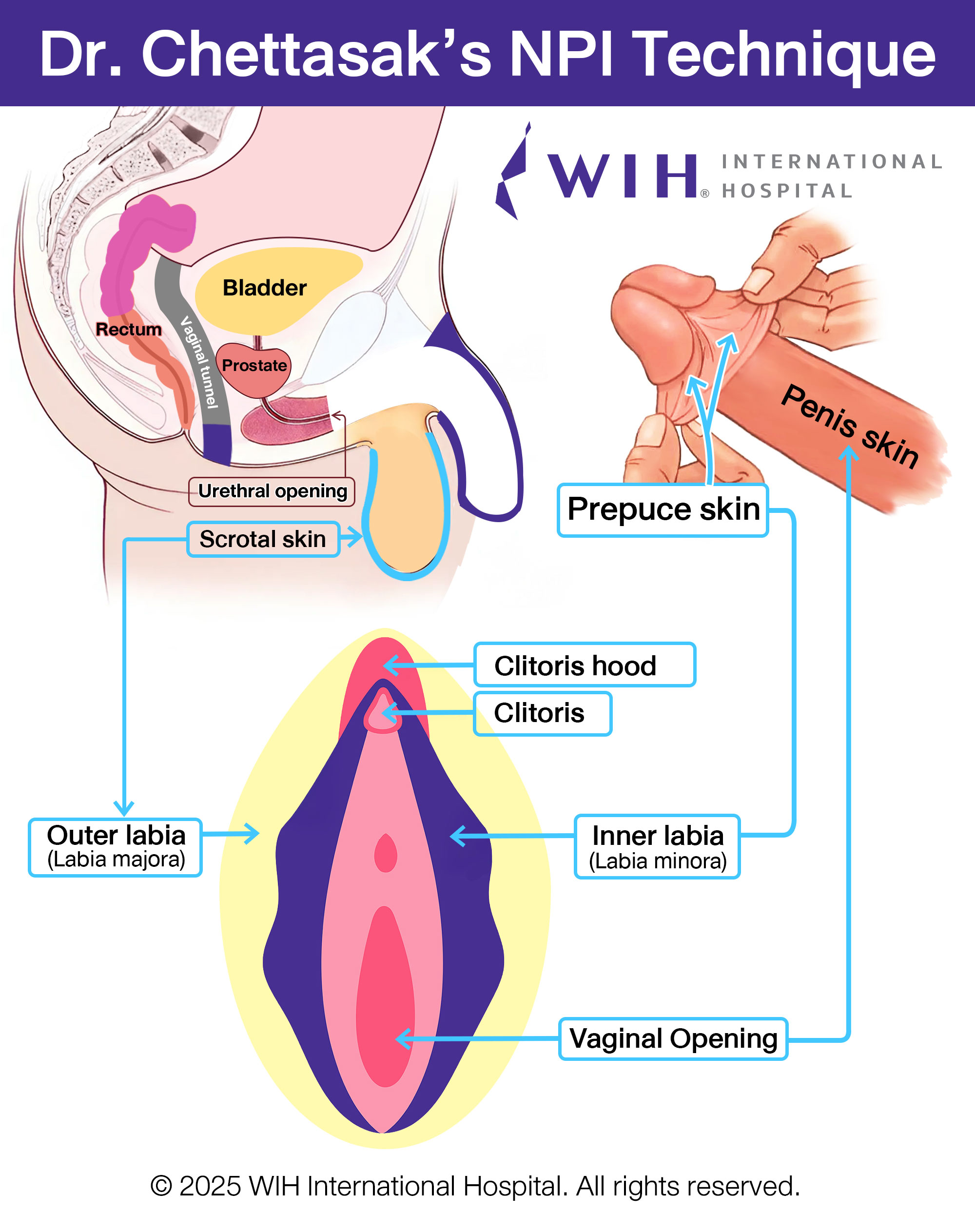 Dr. Chettasak’s NPI Technique for gender affirming surgery
